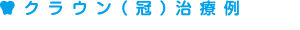 クラウン(冠)治療例